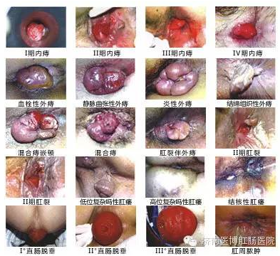 阿克苏外痔不治的危害？怎么治疗？