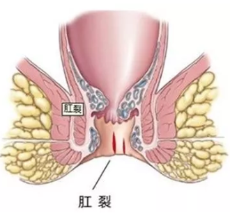 赤肛肠和肛裂是怎么引起的能治好吗