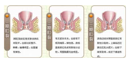 大连金州宁城县肛裂疾病是什么病因引起的？