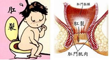 大连金州红山区肛裂能自愈吗？肛裂检查项目