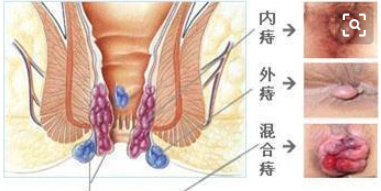 大连金州红山区痔疮方法治怎么处理?可以这样做？